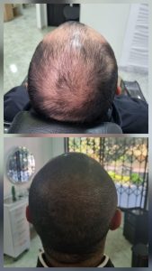 Antes y después micropigmentación capilar