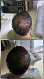 Micropigmentación capilar hombres