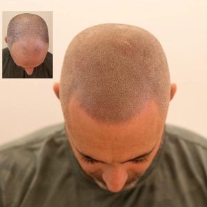 Micropigmentación capilar mujeres