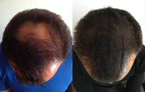 Micropigmentación capilar natural