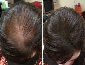 Micropigmentación capilar resultados