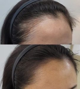 micropigmentación capilar