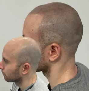 pigmentación capilar