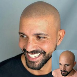 micropigmentacion-capilar-rapados.jpg